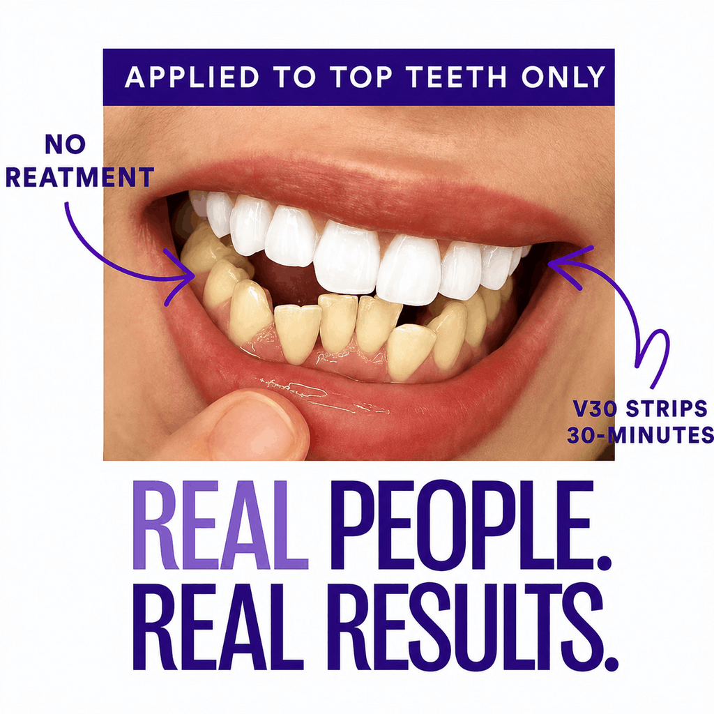 Promotional graphic for a teeth-whitening product showing a close-up of an open mouth with yellowed teeth and a strip applied to the upper teeth. Text reads 'APPLIED TO TOP TEETH ONLY,' 'NO TREATMENT,' 'V30 STRIPS 30-MINUTES,' and 'REAL PEOPLE.