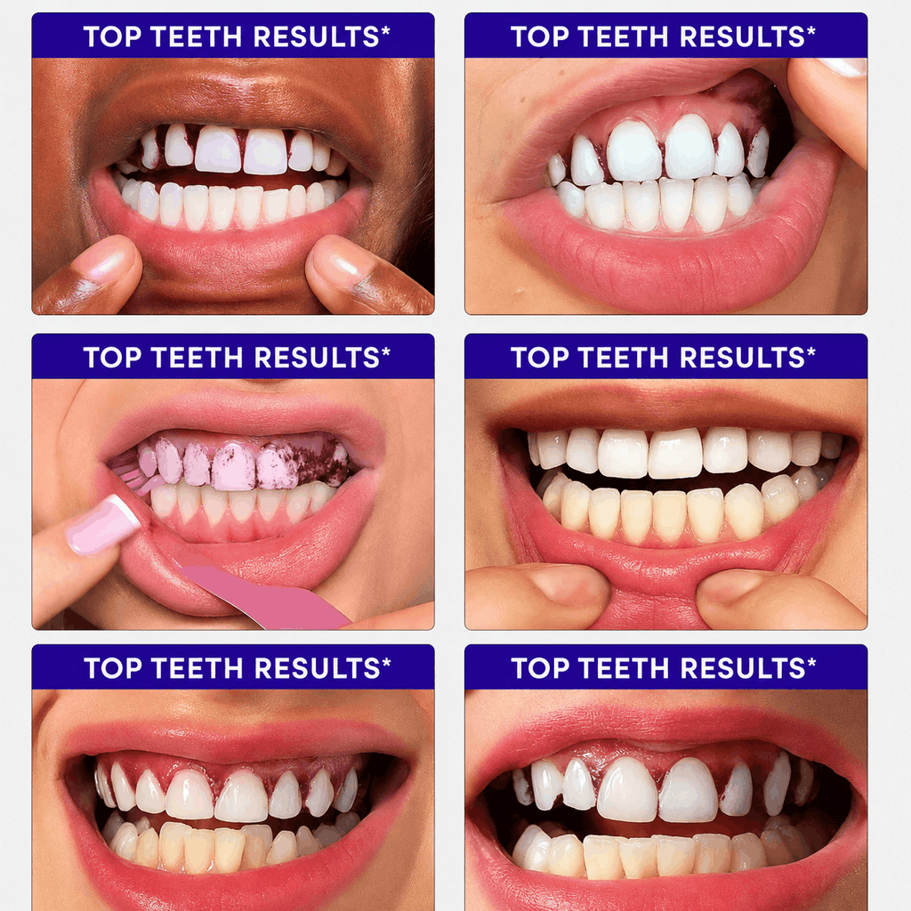 A 2x3 collage of six close-up mouth photos labeled 'TOP TEETH RESULTS*' at the top of each panel, showing teeth before and after whitening or cleaning results.