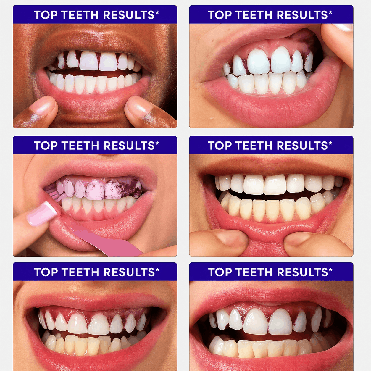 A 2x3 collage of six close-up mouth photos labeled 'TOP TEETH RESULTS*' at the top of each panel, showing teeth before and after whitening or cleaning results.