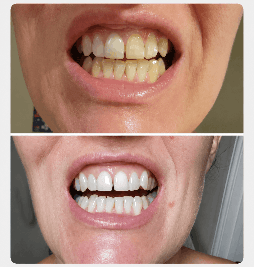 A before-and-after comparison of a person's teeth, showing yellowed teeth in the top photo and bright, white teeth in the bottom photo.